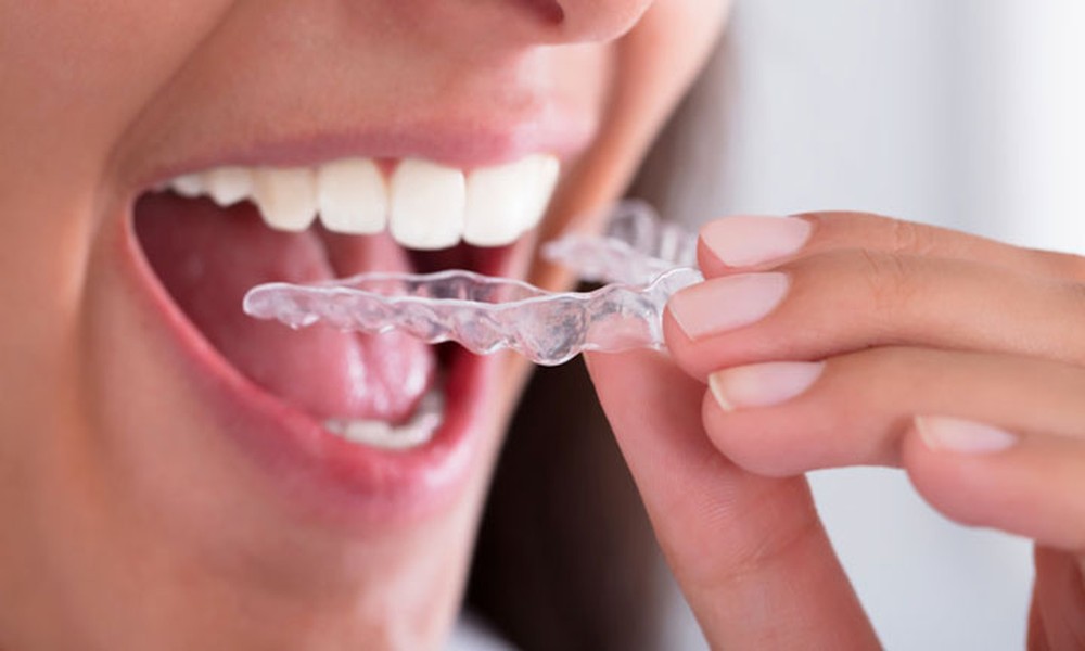 How General Dentists Customize Night Guards For Tooth Protection
