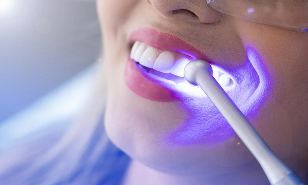 4 Common Cosmetic Dental Treatments Explained Simply
