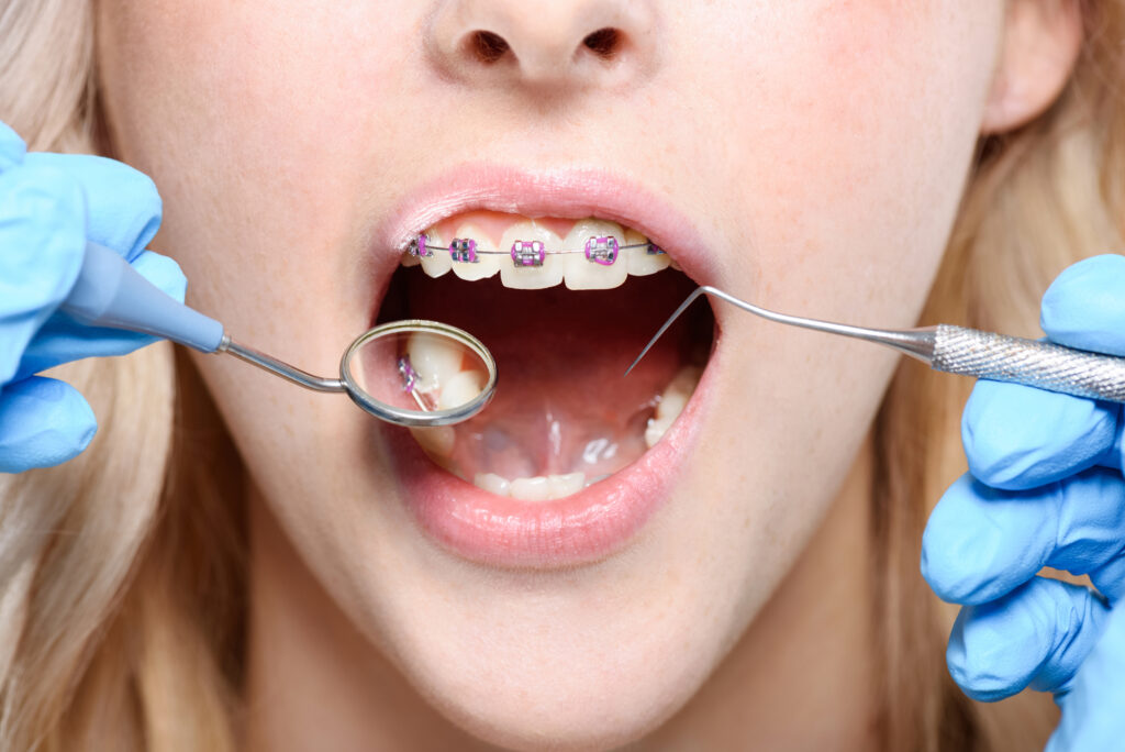 4 Benefits Of Starting Orthodontics With A General Dental Exam