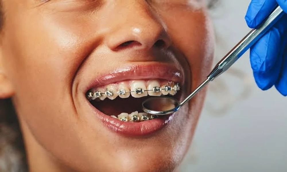 The Connection Between Preventive Dentistry And Orthodontic Results