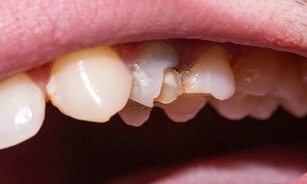 7 Causes Of Tooth Discoloration That Require Different Dental Cosmetic Solutions